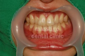 치아미백 전후 증례