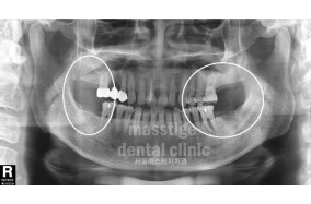 어금니 임플란트 전후 증례