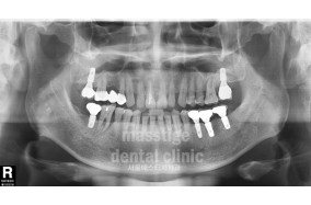 어금니 임플란트 전후 증례