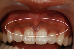 잇몸미백 전후 증례