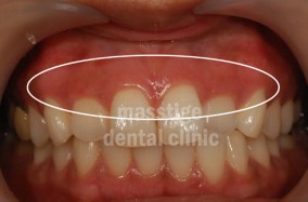 잇몸미백 전후 증례